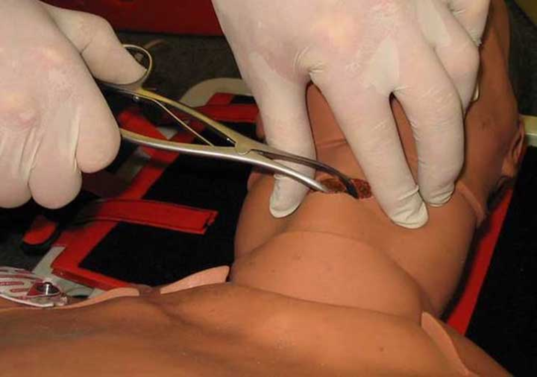 image of dilators spreading incision