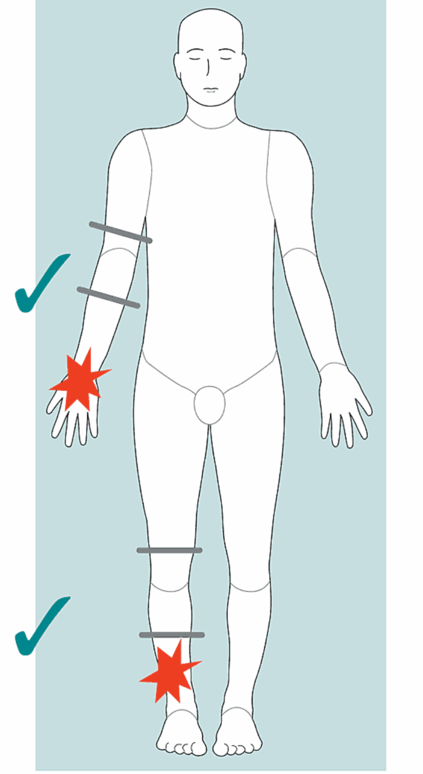 diagram of upper limb and lower limb tourniquet positions